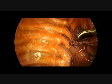 Thorakoskopische Resektion der Lungenspitze bei spontanem Pneumothorax
