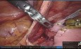 Robotische Duodenojejunostomie beim A.-mesenterica-superior-Syndrom