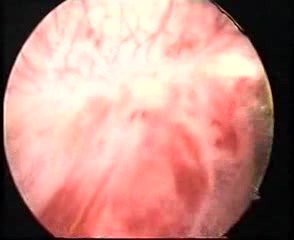 Operative Hysteroskopie bei dem endometrialen Polyp