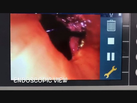 Roboterassistierte Thoraxchirurgie - Bronchoplastische Resektion des linken Hauptbronchus