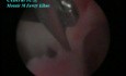 Zentrale intrauterine Adhäsionen nach Kaiserschnitt - laparoskopische Behandlung
