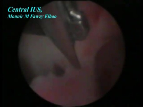 Zentrale intrauterine Adhäsionen nach Kaiserschnitt - laparoskopische Behandlung