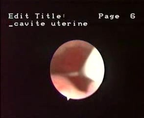 Intrauterinpessar- diagnostische Hysteroskopie