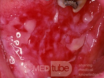 Erosiver Lichen planus