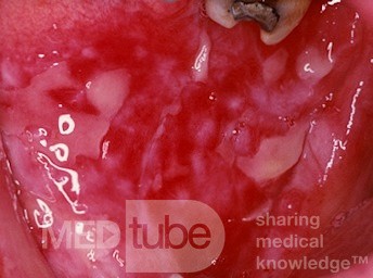 Erosiver Lichen planus