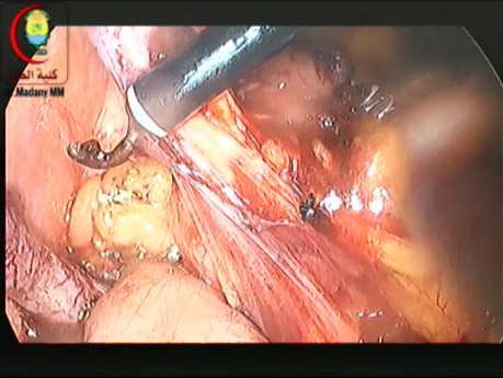 Bei stark adipösen Patienten mit einem fettigen Mesoappendix und Verwachsungen einer vorherigen Kaiserschnitt-Operation sollten Sie versuchen, das Zurücklassen eines Stumpfes zu vermeiden.