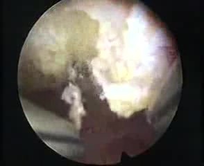 RESECTION MASTER System und Endometriumpolypen