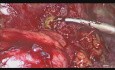 Laparoskopische Behandlung von Colodermale und Colovaginale Fistel  als Komplikationen der Divertikulose