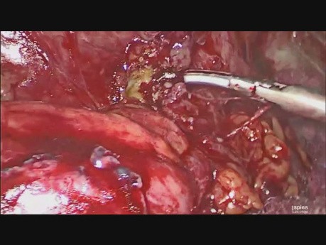 Laparoskopische Behandlung von Colodermale und Colovaginale Fistel  als Komplikationen der Divertikulose