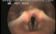 Akute Laryngitis 