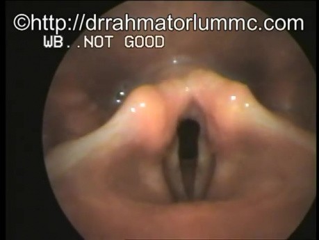 Akute Laryngitis 