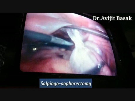Eierstockzyste mit Komplikationen ( Ovarialtorsion und Adhäsionen)- Laparoskopie