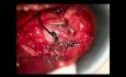 Halswirbelsäulenchirurgie nach der Frykholm-Methode