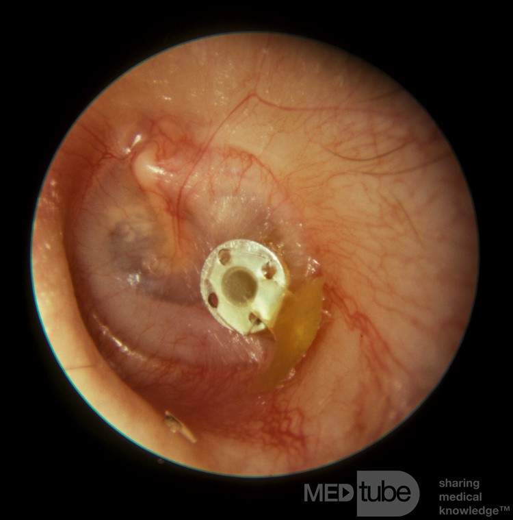 Muköse Otitis Media - Sekretabfluss