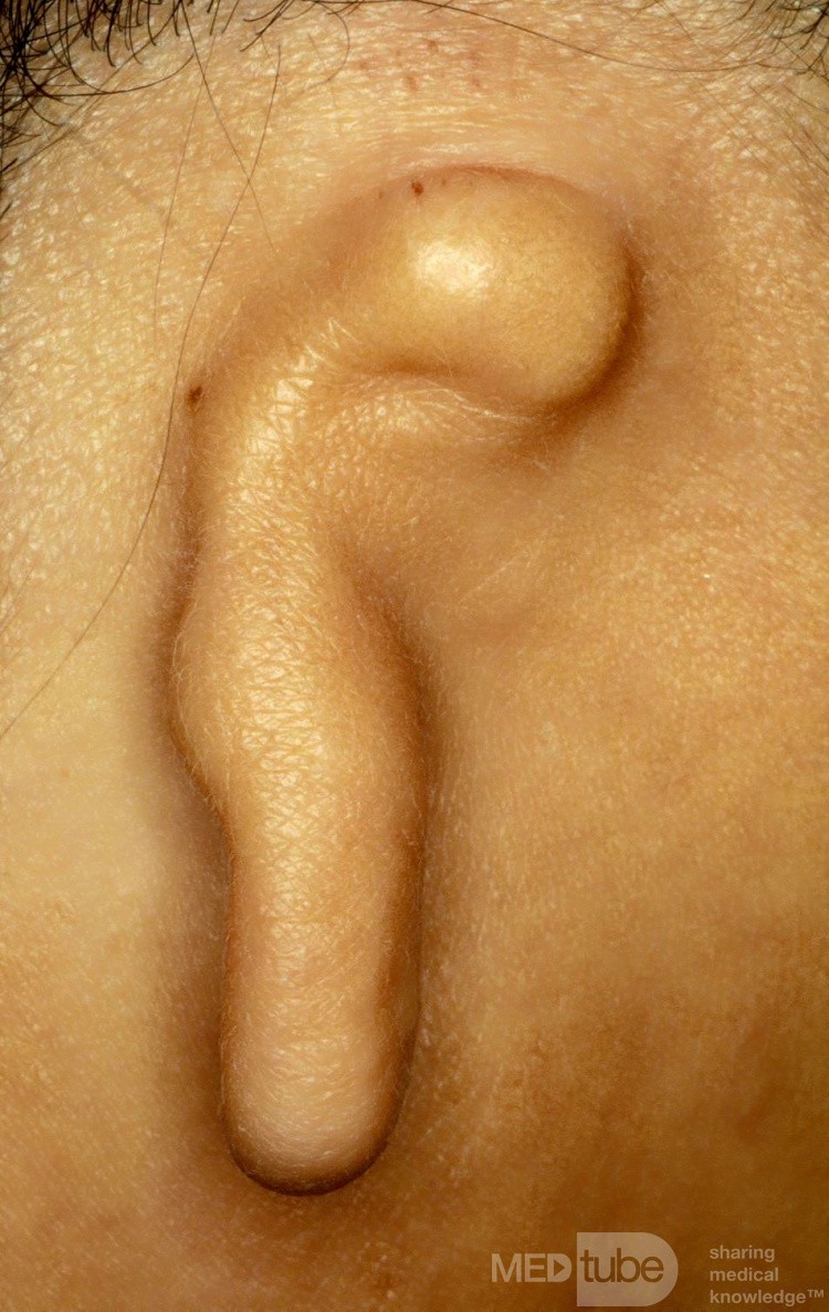 Mikrotie rechts
