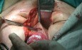 Beckenanatomie - avaskulärer vesikulär-vaginaler Raum
