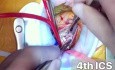 Dreifachklappeneingriff und CABG über linksanteriore Thorakotomie