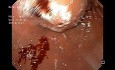 Submuköse Läsion(en) im Magen und Zwölffingerdarm