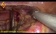 Thorako-Laparoskopische Ösophagektomie – Thorax Teil 3