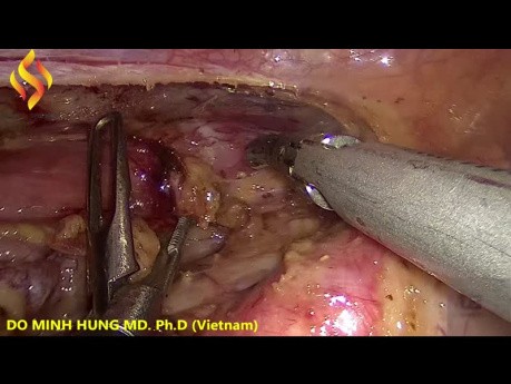 Thorako-Laparoskopische Ösophagektomie – Thorax Teil 3