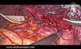 Lange Myotomie bei Achalasie