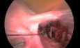 Laparoskopische Myomektomie: Ligatur der Arteria uterina