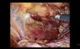 Viermal wiederkehrender Leistenbruch. Erfolgreiche laparoskopische Reparatur.