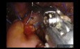 Robotische Pankreatikoduodenektomie mit Cholezystektomie bei soliden pseudopapillären Neoplasien
