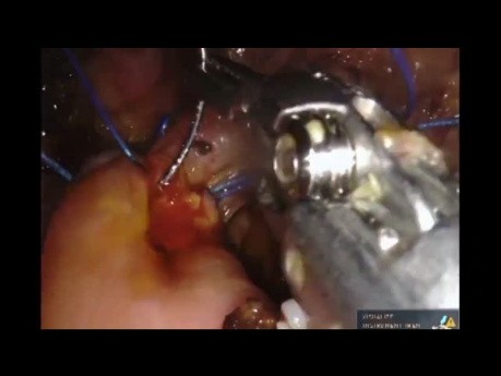 Robotische Pankreatikoduodenektomie mit Cholezystektomie bei soliden pseudopapillären Neoplasien