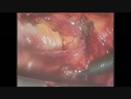 Laparoskopische Nabelbruchreparatur
