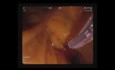 Zwölffingerdarmschnitt und ERCP mit Gallenstenting (SEMS)