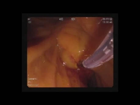 Zwölffingerdarmschnitt und ERCP mit Gallenstenting (SEMS)