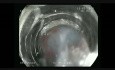 Minimal-invasive endoskopische Techniken bei der Behandlung von neuroendokrinen Tumoren im Magen