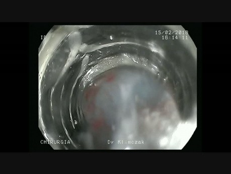 Minimal-invasive endoskopische Techniken bei der Behandlung von neuroendokrinen Tumoren im Magen