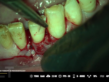 Mikrochirurgische Lasertherapie in der Parodontologie