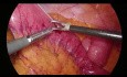 Vorbereitung der Ernährungs-Jejunostomie durch laparoskopische Methode