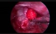 Endoskopischer transkanaler infracochleärer Zugang (Petrous Apex Granuloma)