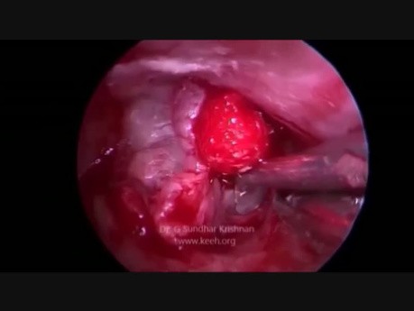 Endoskopischer transkanaler infracochleärer Zugang (Petrous Apex Granuloma)