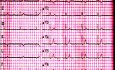 EKG-Quiz 1. Ein Elektrokardiographie-Fall. Ein Patient mit Schwäche und Schwindel