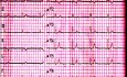 EKG-Quiz 1. Ein Elektrokardiographie-Fall. Ein Patient mit Schwäche und Schwindel
