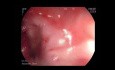Ein seltener Fall von Blutungen im oberen Gastrointestinaltrakt