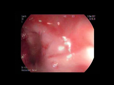 Ein seltener Fall von Blutungen im oberen Gastrointestinaltrakt