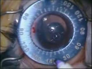 Implantation von Intraokularlinsen