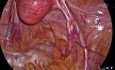 Totale laparoskopische Hysterektomie – retroperitoneale Dissektion, erklärt von Dr. Kunal Rathod