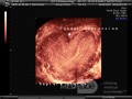 Uterus bicornis (3D-Ultraschall)