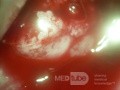 Zervikales Adenokarzinom (Carcinoma glandulare colli uteri)