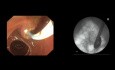 Endoskopische retrograde Cholangiopankreatikographie (ERCP) bei einem Patienten nach Billroth-II-Resektion