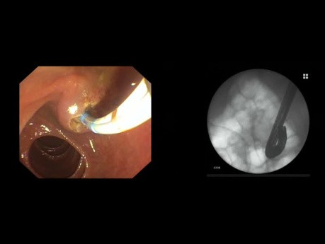 Endoskopische retrograde Cholangiopankreatikographie (ERCP) bei einem Patienten nach Billroth-II-Resektion