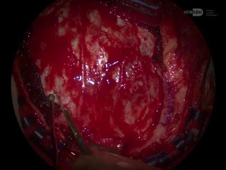 Rechtsseitige Kraniotomie und Resektion eines posterior temporalen sylvischen AVM