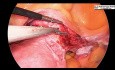 Totale laparoskopische Hysterektomie mit Indocyaningrün-(ICG)-Anfärbung 